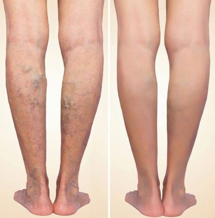 Home antes y despues