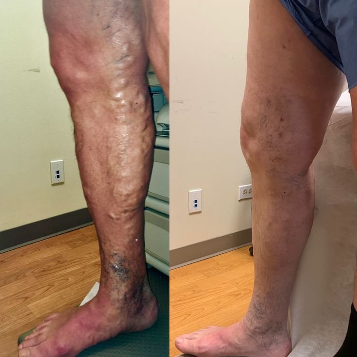 Home hombresvenas despues